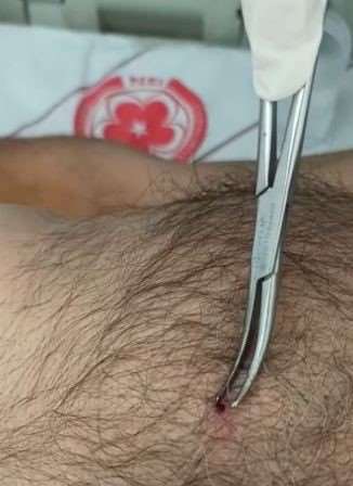 Bu belirtileri taşıyanlarda KKKA virüsü görülebilir