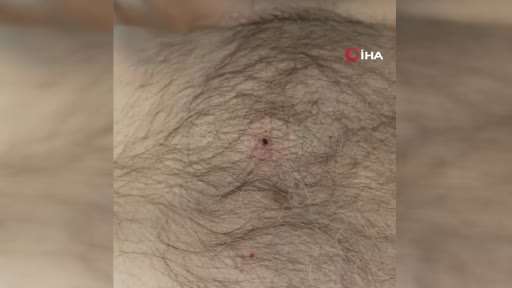 Bu belirtileri taşıyanlarda KKKA virüsü görülebilir